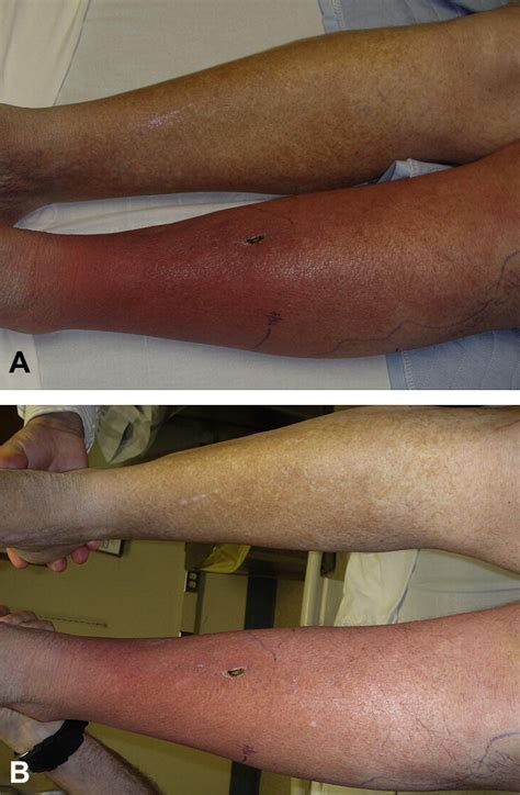 Lower Limb Cellulitis And Its Mimics Journal Of The American Academy Of Dermatology