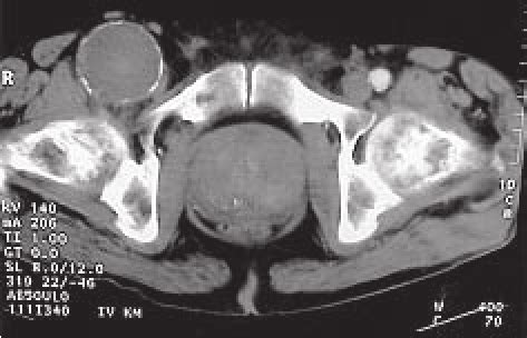 CT scan of a large femoral aneurysm. | Download Scientific Diagram