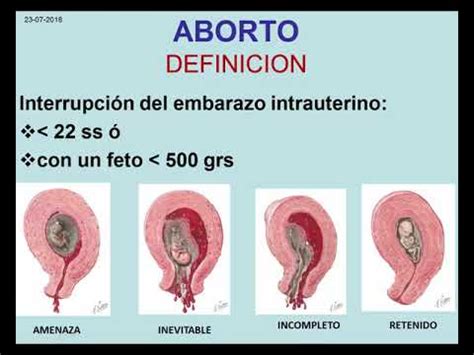 Hemorragias Primera Mitad Del Embarazo Obstetricia Clase Youtube