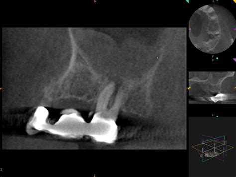 Maxillary Sinus Perforation Treatment