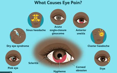 5 Ways Lupus Affects the Eyes