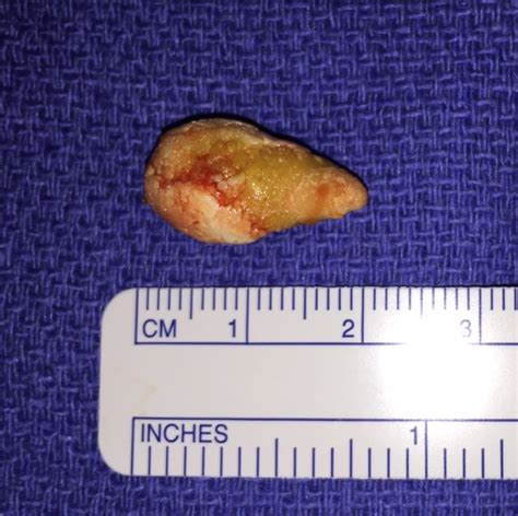 What are salivary stones?