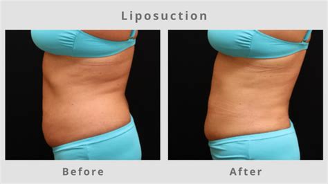 Memphis Liposuction Surgical Fat Removal Lipo