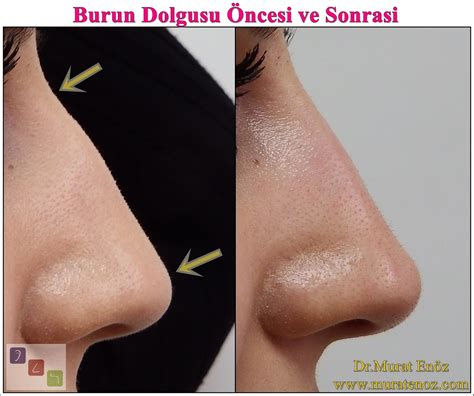 Burun Dolgusu Öncesi Ve Sonrası Fotoğrafları