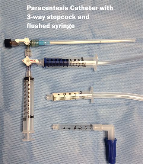 How To Use Continuous Wall Suction For Paracentesis Page Of