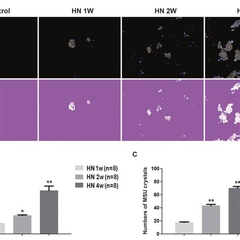 Monosodium Urate Msu Crystal Deposits In The Kidneys Of Hyperuricemic