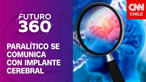 Hombre paralítico logra comunicarse gracias a implante cerebral