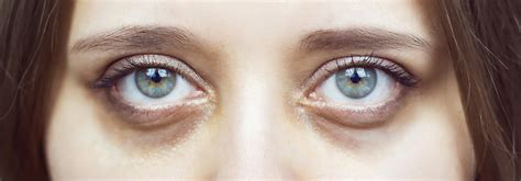 What Causes Dark Circles Under Eyes Renew Medical Aesthetics Cheshire Clinic