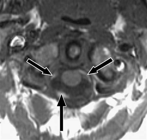 Normal Mri Appearance And Motion Related Phenomena Of Csf Ajr