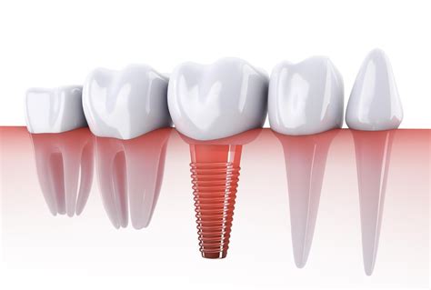 Implante Dentário função tipos e curiosidades Like Odonto