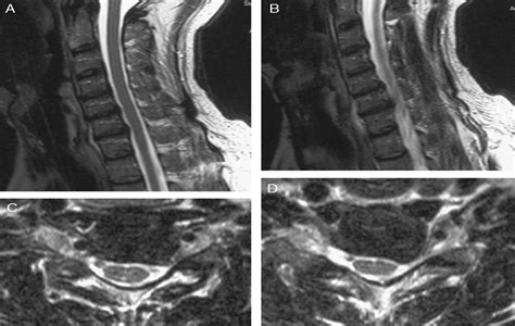 Minimally Invasive 2 Level Posterior Cervical Foraminotomy