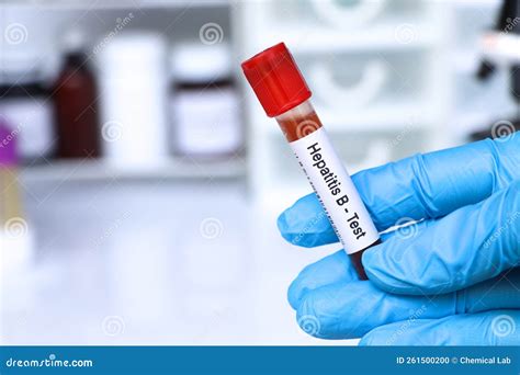 Hepatitis B Test To Look For Abnormalities From Blood Stock Photo