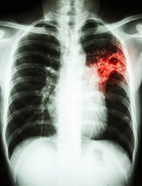 Pulmonary Tuberculosis Collection Chest X Ray Show Patchy Infiltration Interstitial