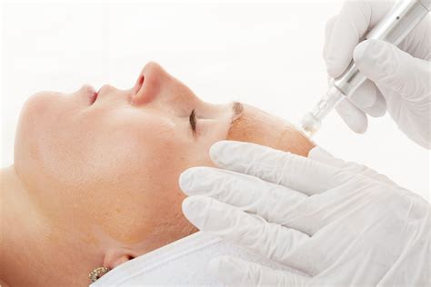 MICRONEEDLING VAMPIRE LIFTING Élan Esthetics in Bad Homburg