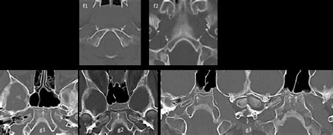 Figure 11 From The Ossification Process Of The Occipital Bone And Normal Variants Evaluation By