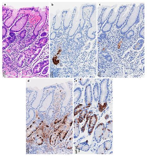 Clue of Diagnosis for Autoimmune Gastritis : 대한자가면역성위염연구회