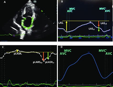 Two Dimensional Speckle Trackling Echocardiography A The Complete