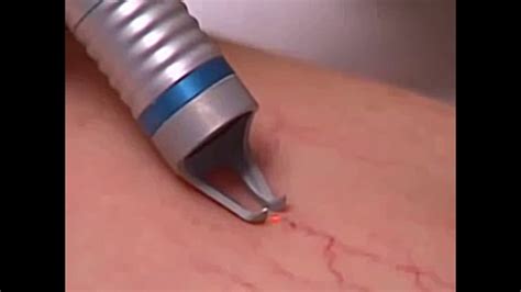 Varicose Veins Removal Machine 980nm Laser Spider Vein Removal Youtube