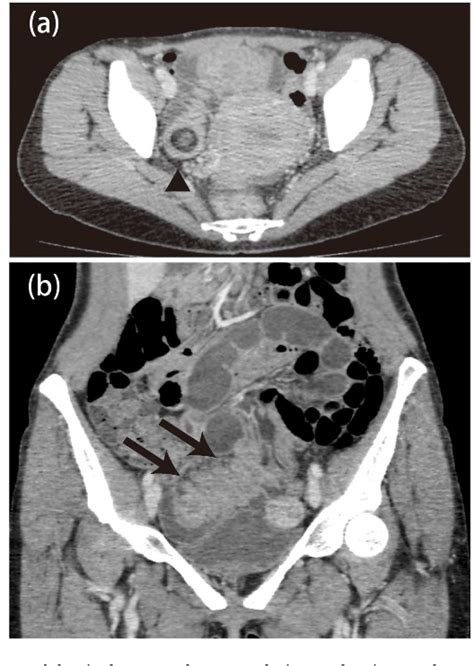 Figure From Ileectomy Performed On A Case Of Adult Intussusception