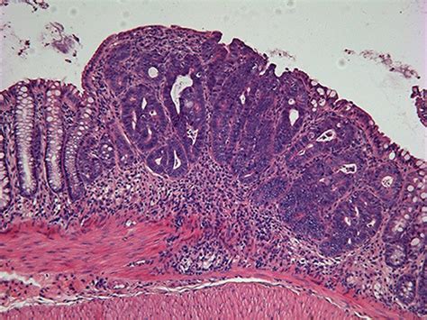 Dosis altas de vitamina D muestran beneficios en pacientes con cáncer