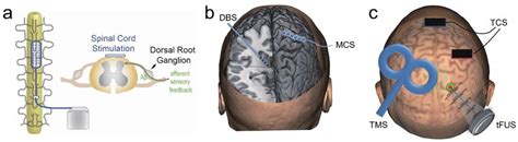 Neuromodulation Management Of Chronic Neuropathic Pain In The Central