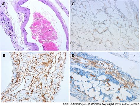 Pathologic Findings Of The Venous Hemangioma A The Specimen Tissues