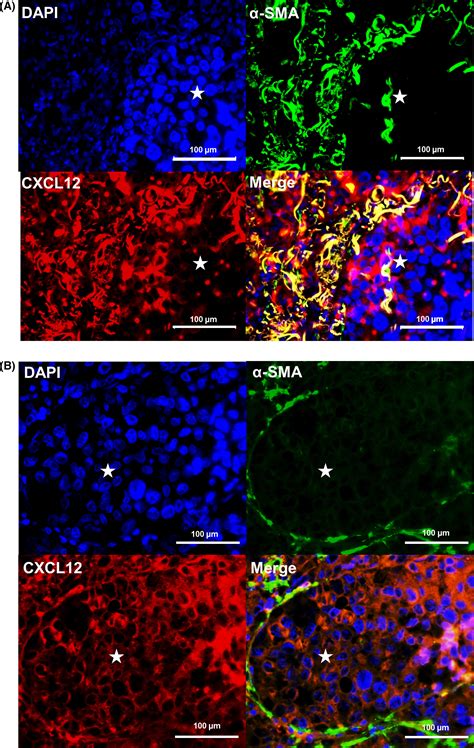 Correlation Between Cxcr Cxcr Cxcl Chemokine Axis Expression And