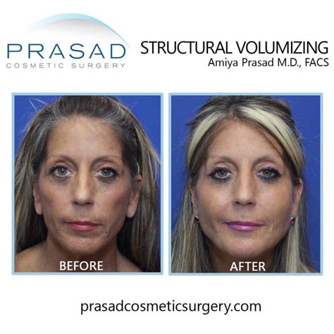 Y Lift Liquid Facelift Results Can Last Anywhere Between Years