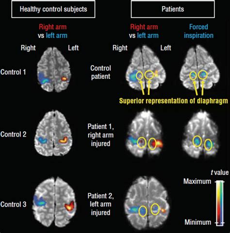 Plasticity In FMRI And DTI Radiology Key