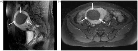 Full Article Uterine Myomas Treated With Microwave Ablation The