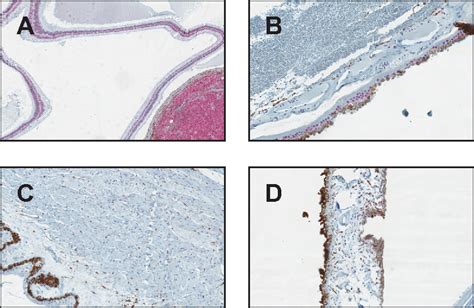 Figure From Diagnostic Value Of Sox Immunohistochemical Staining