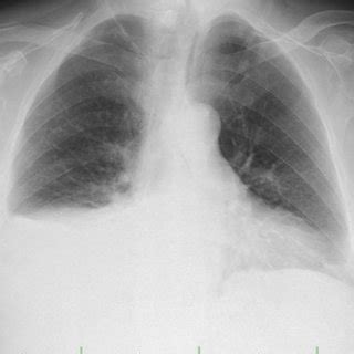 Pdf A Case Of Chylothorax Due To Diffuse Large B Cell Lymphoma