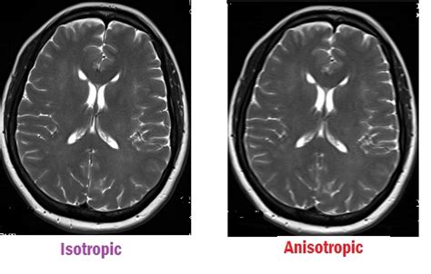 Optimizing Resolution in MRI - RITE Advantage