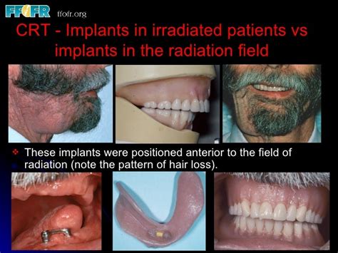 8.implant in irradiated patients