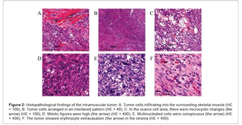 Diagnostic Pathology Open Access Large Size Intramuscular Nodular Fasciitis A Challenging