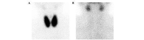 Differentiation Between Graves Disease And Painless Thyroiditis By