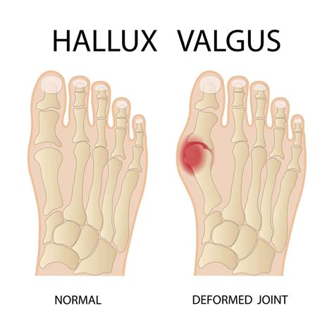 infographie médicale de l hallux valgus illustration vectorielle