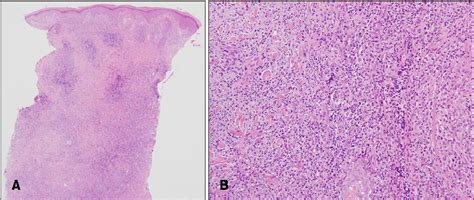 Figure 2 From A Case Of Primary Cutaneous Cd4 Positive Small Medium T