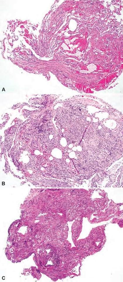 Optimal Processing Of Diagnostic Lung Specimens Practical Pulmonary