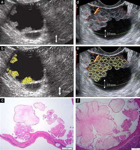 Ovarian Cancer Ultrasound