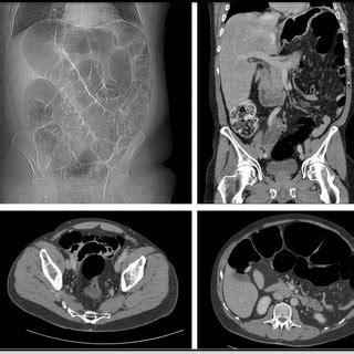 Initial Computed Tomography Ct Abdomen And Pelvis Scan Findings On