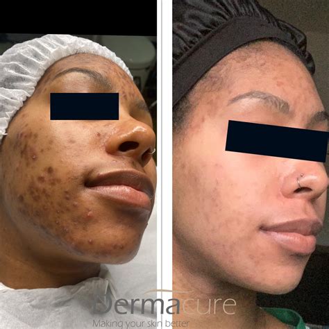 Cosmelan Peel London Number 1 Depigmentation Treatment Dermacure Clinic