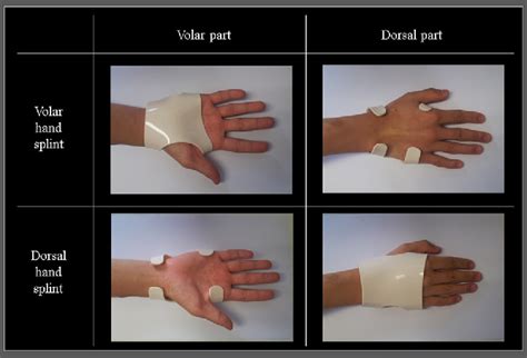 Volar Vs Dorsal Surface