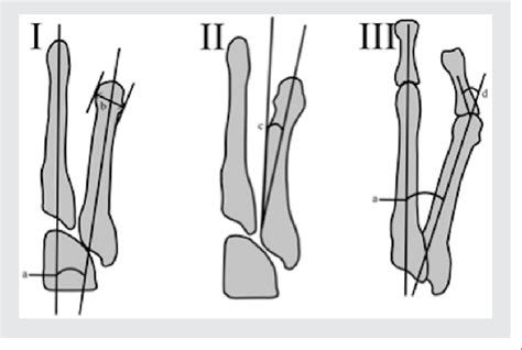 Figure From The Reverse Ludloff Osteotomy For Bunionette Deformity