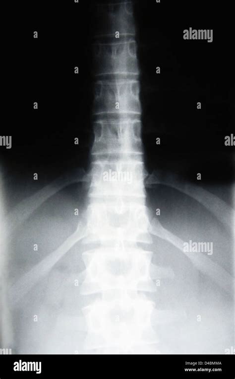 X Ray Lower Back Hi Res Stock Photography And Images Alamy