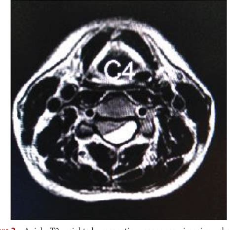 Figure 3 From Acute Spontaneous Epidural Hematoma Of Cervical Spine