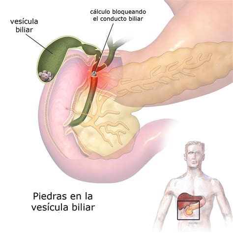 Porque Se Producen Los Calculos En La Vesicula Biliar Form Example