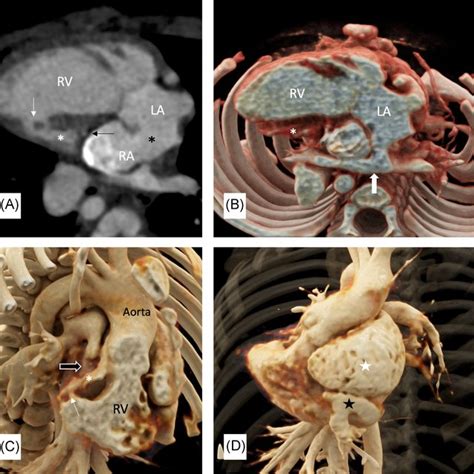 VR Image Showing Duplicated Origin Of Right Vertebral Artery RVA And