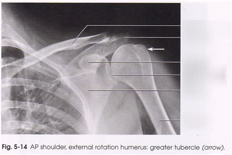 AP Shoulder Radiograph Diagram Quizlet