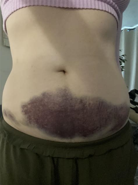 This Bruise From My Seatbelt After A Car Accident R Pics